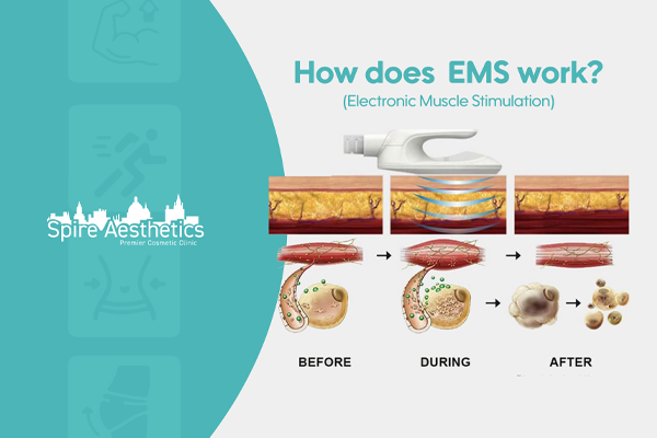 EMS treatment for post pregnancy weight loss treatment West Bromwich