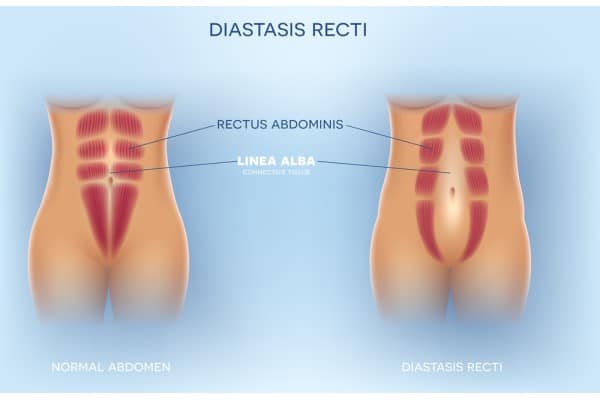 What Non-Surgical Options Are Available for Diastasis Recti West Bromwich?