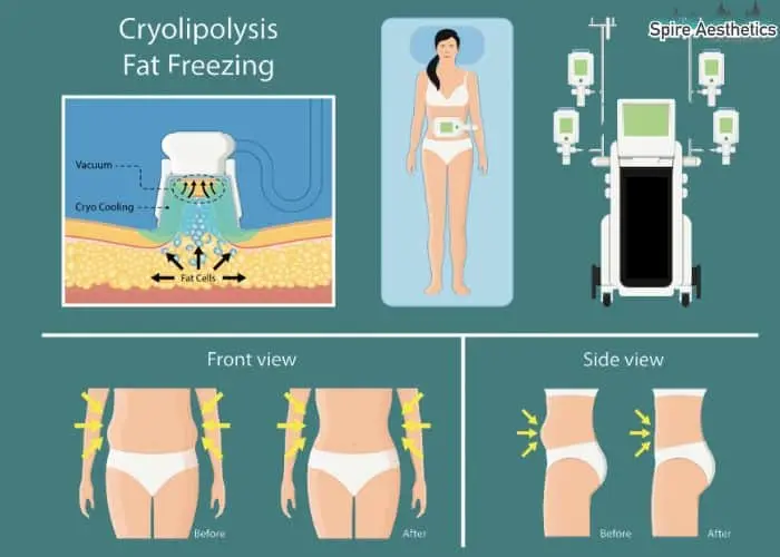 Fat freezing treatment West Bromwich benefits for competitions to remove stubborn fat deposits.