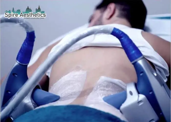 Man having fat freezing treatment done on love handles before a competitions West Bromwich to create a sculpted look.