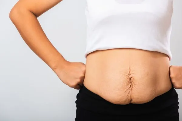 Image of a woman's stomach after weight loss with sagging skin following a gastric band West Bromwich