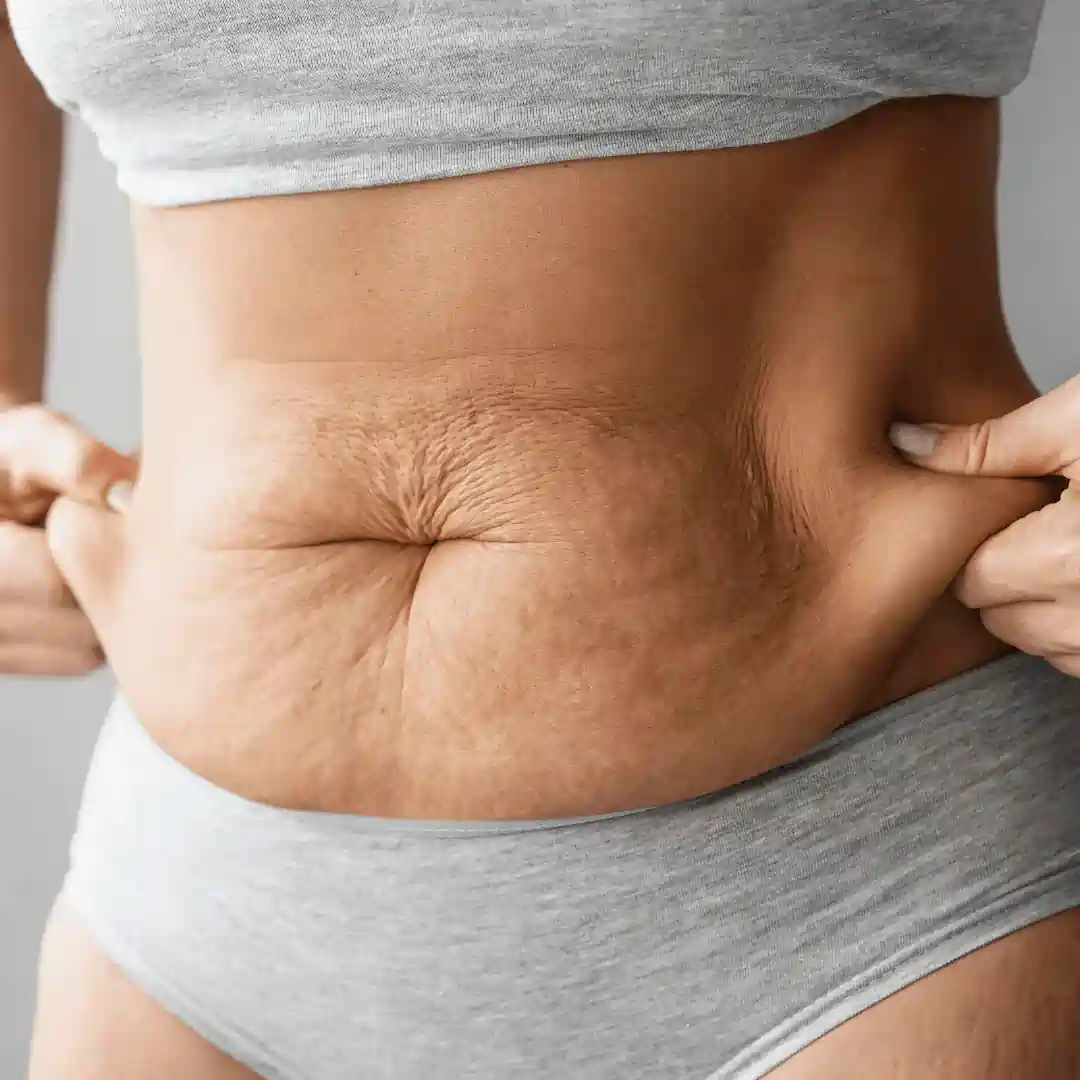 Is It Normal to Have Loose Skin After Pregnancy West Bromwich?