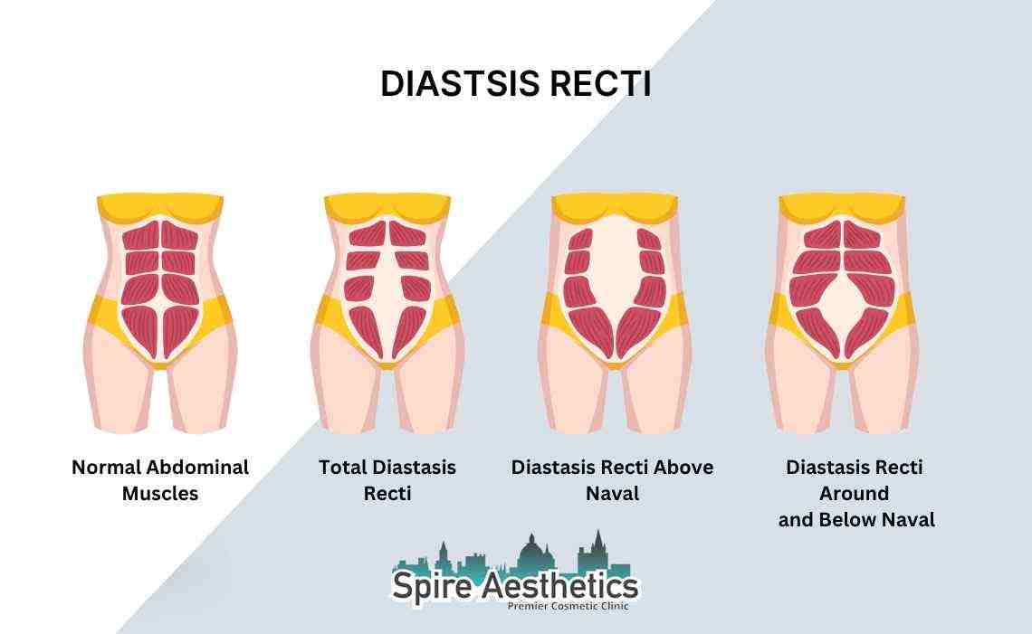 Is Non-Surgical Diastasis Recti Treatment Right for You? Common Concerns Answered West Bromwich